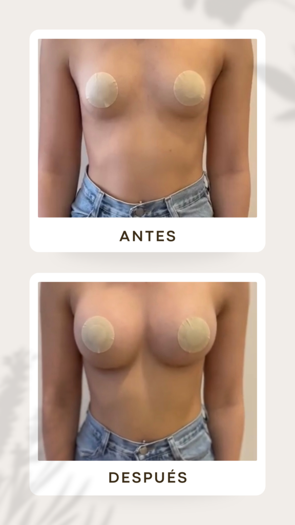 Aumento mamario